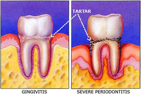 Periodontic Therapy