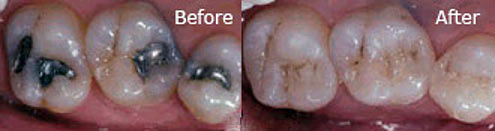 Dental Restoration